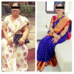 Jupiter-Hospital-Bariatric-Surgery-Before-and-After-1.jpg